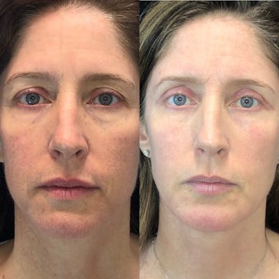 Sciton Halo Before & After Gallery - Patient 81641120 - Image 1