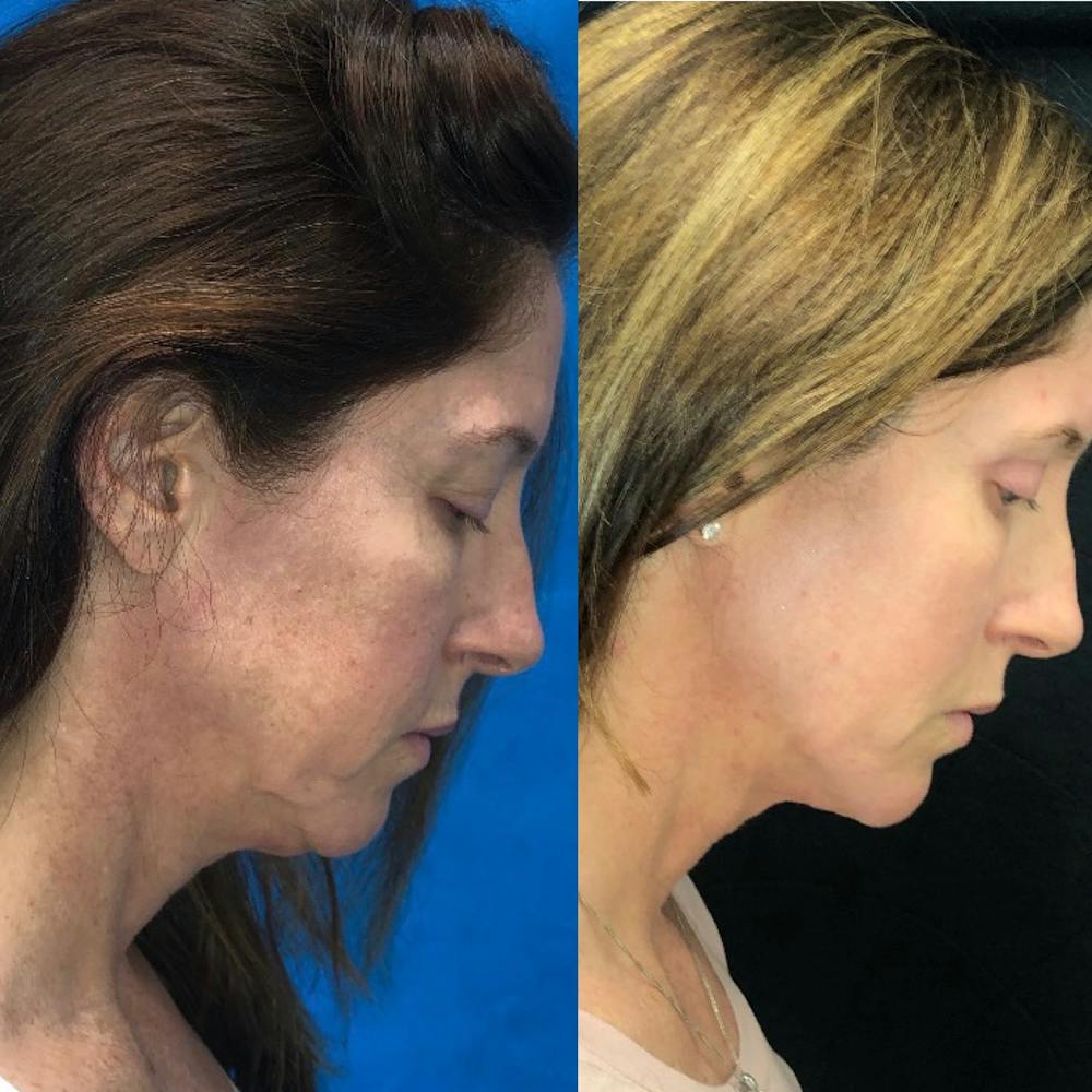 Submental Liposuction Before & After Gallery - Patient 81640398 - Image 3