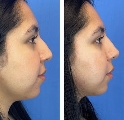 Non-Surgical Rhinoplasty Before & After Gallery - Patient 172499 - Image 1