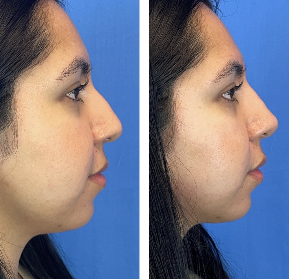 Non-Surgical Rhinoplasty Before & After Gallery - Patient 94918447 - Image 1