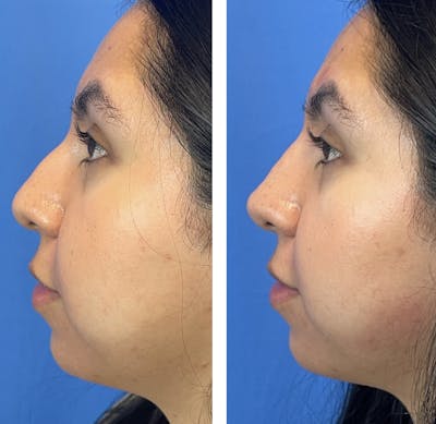 Non-Surgical Rhinoplasty Before & After Gallery - Patient 172499 - Image 2