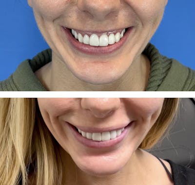 BOTOX Before & After Gallery - Patient 94918473 - Image 1