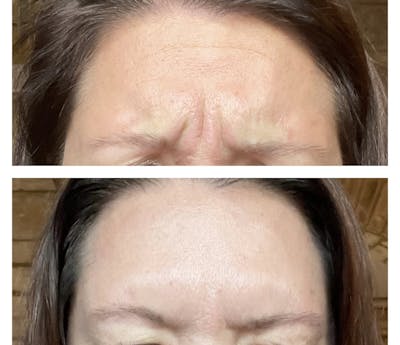 BOTOX Before & After Gallery - Patient 94918474 - Image 1