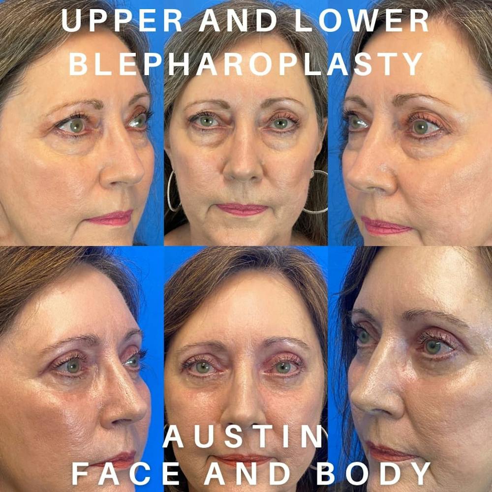 Upper Blepharoplasty Before & After Gallery - Patient 96893046 - Image 1