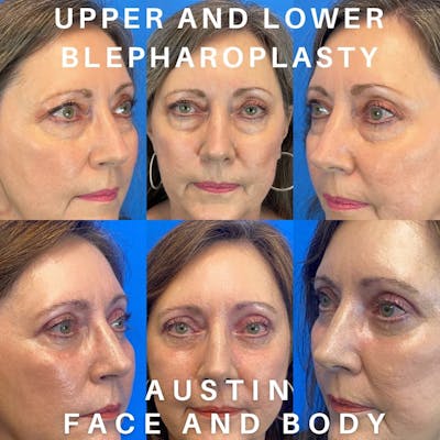 Lower Blepharoplasty Before & After Gallery - Patient 96904739 - Image 1