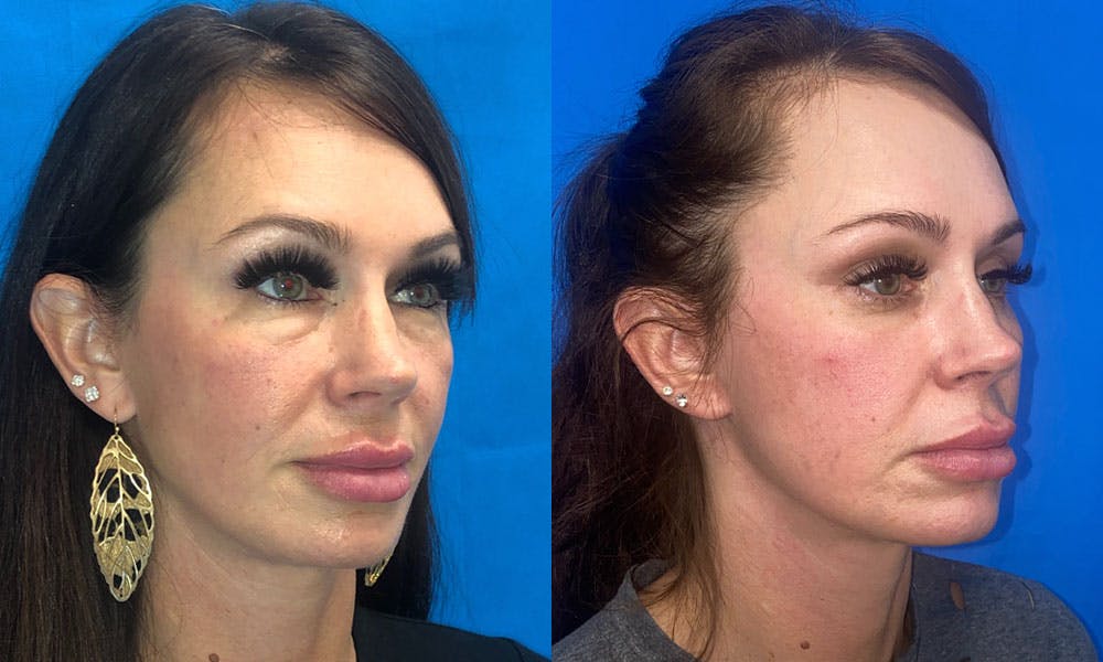 Lower Blepharoplasty Before & After Gallery - Patient 96911104 - Image 1