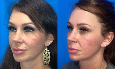 Dermal Fillers Before & After Gallery - Patient 96911115 - Image 2