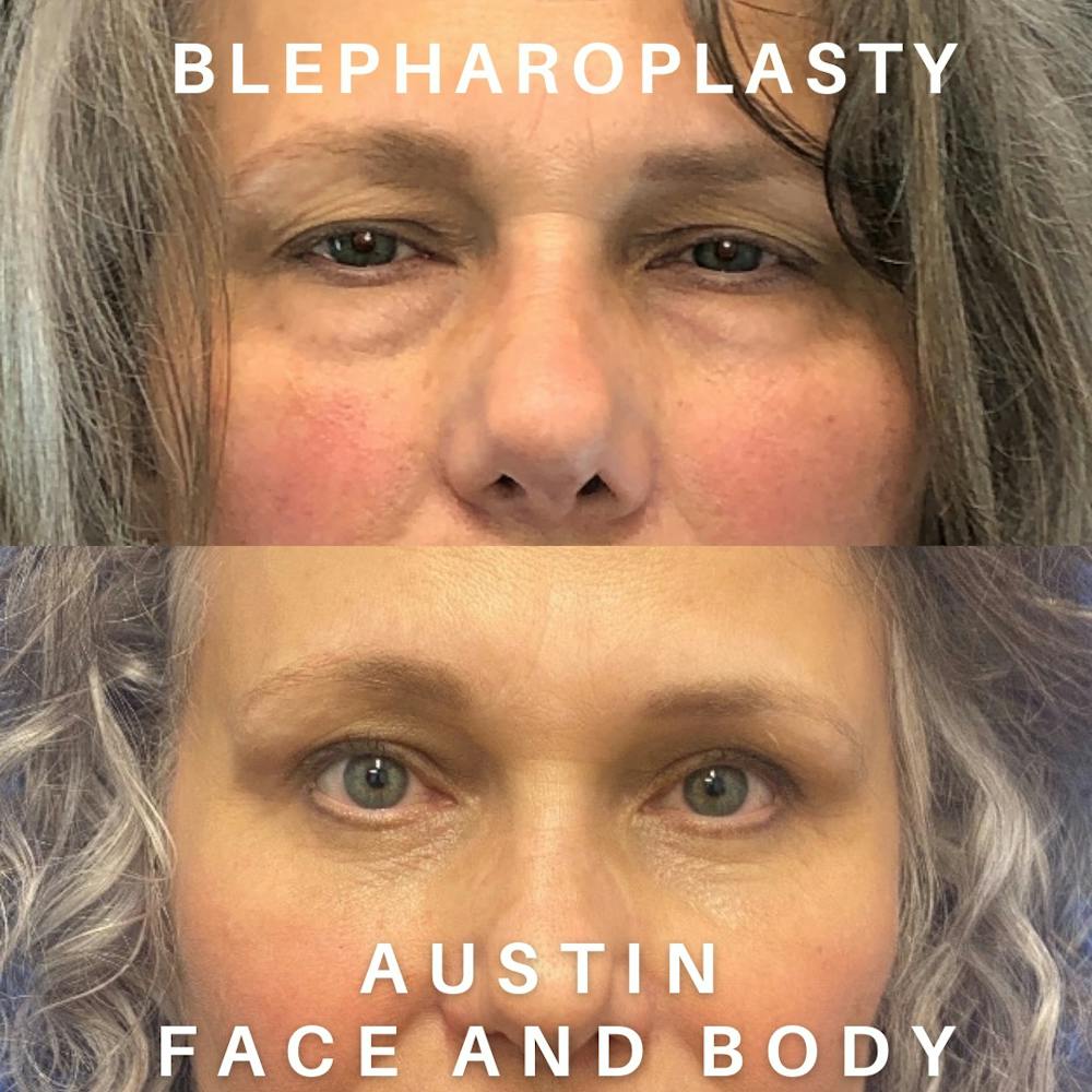 Upper Blepharoplasty Before & After Gallery - Patient 97743589 - Image 1