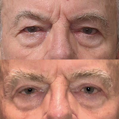 Upper Blepharoplasty Before & After Gallery - Patient 99071756 - Image 1