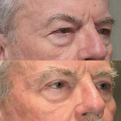 Upper Blepharoplasty Before & After Gallery - Patient 99071756 - Image 2