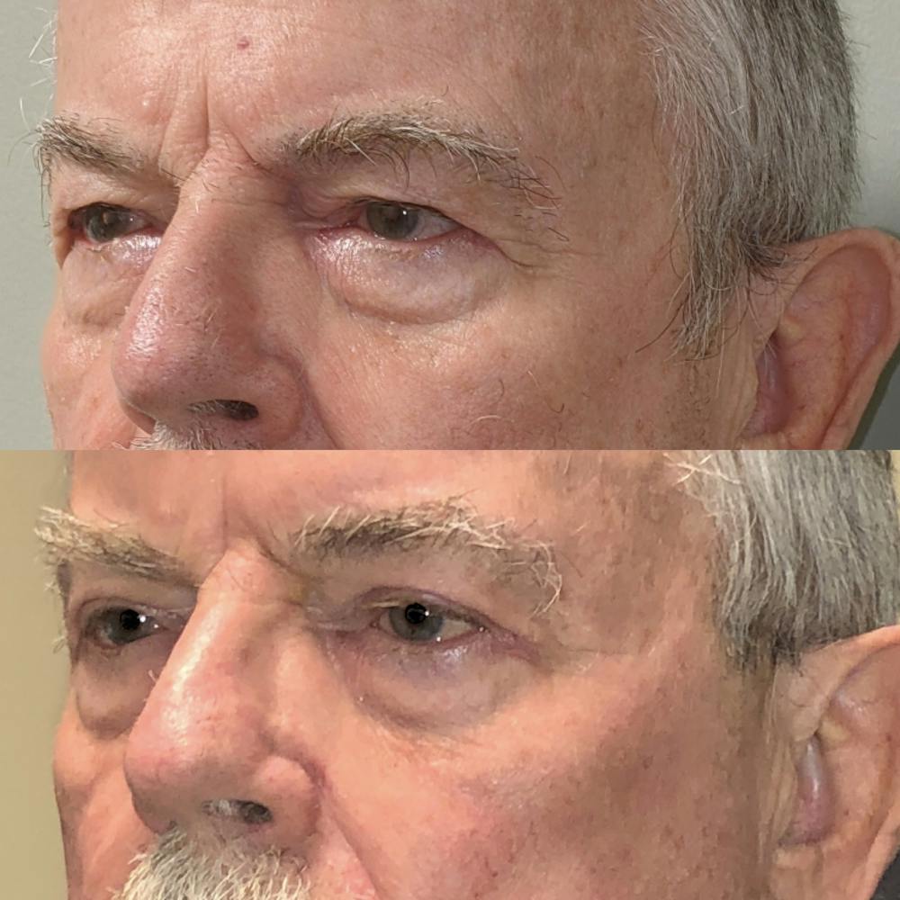 Upper Blepharoplasty Before & After Gallery - Patient 99071756 - Image 3