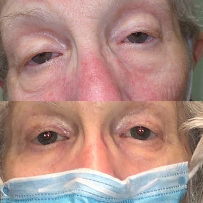 Ptosis Before & After Gallery - Patient 99071804 - Image 1