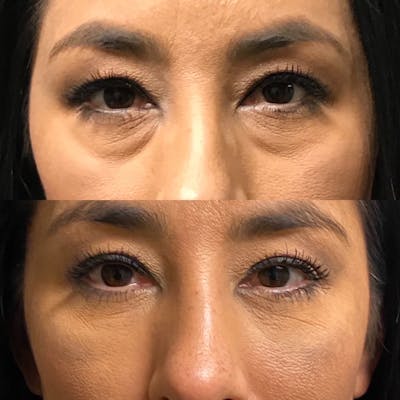 Lower Blepharoplasty Before & After Gallery - Patient 99071825 - Image 1
