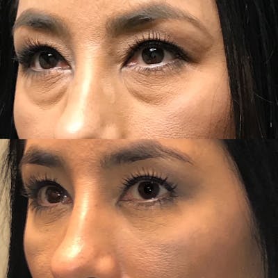 Lower Blepharoplasty Before & After Gallery - Patient 99071825 - Image 2