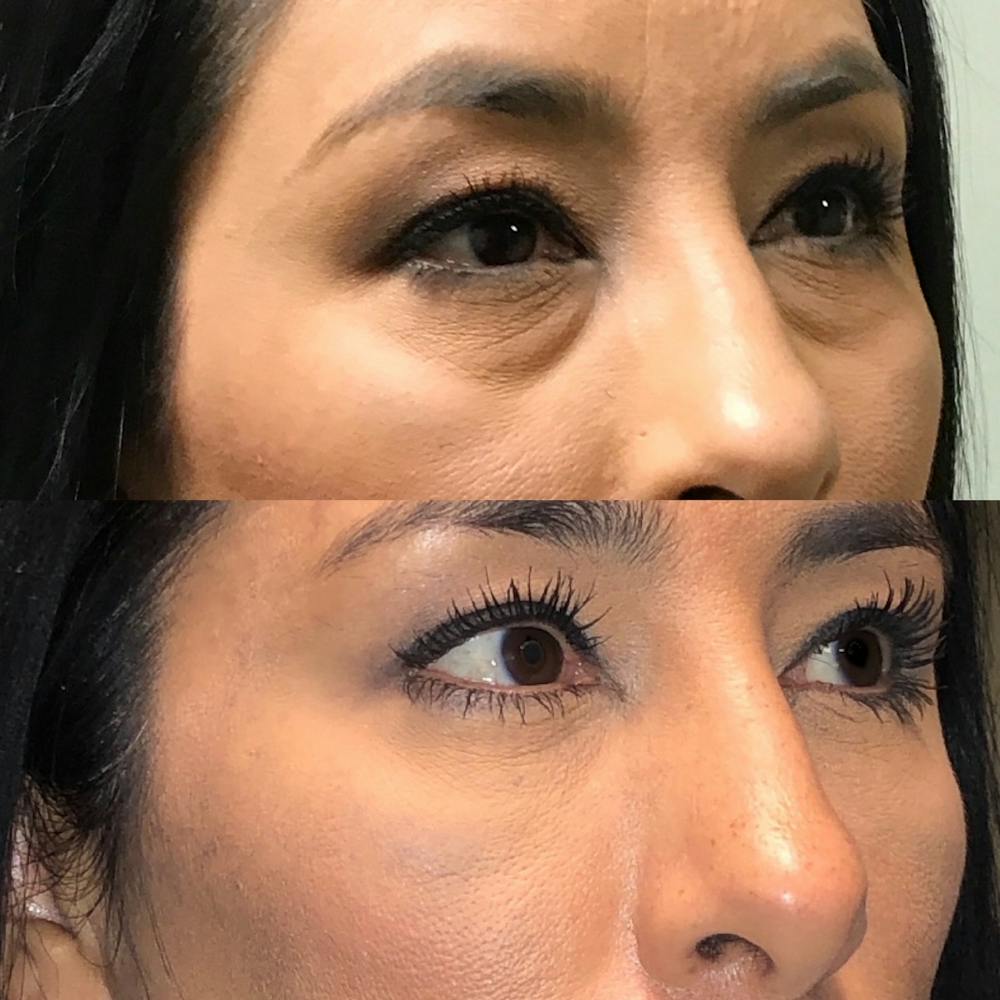 Lower Blepharoplasty Before & After Gallery - Patient 99071825 - Image 3