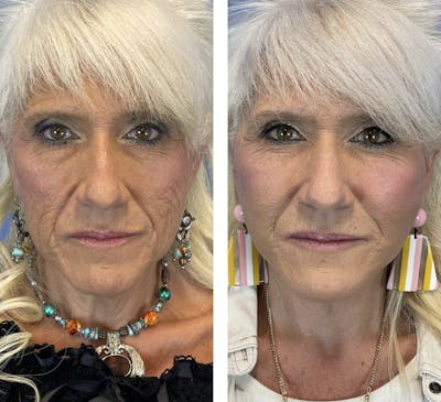 Facelift Before & After Gallery - Patient 101164267 - Image 8