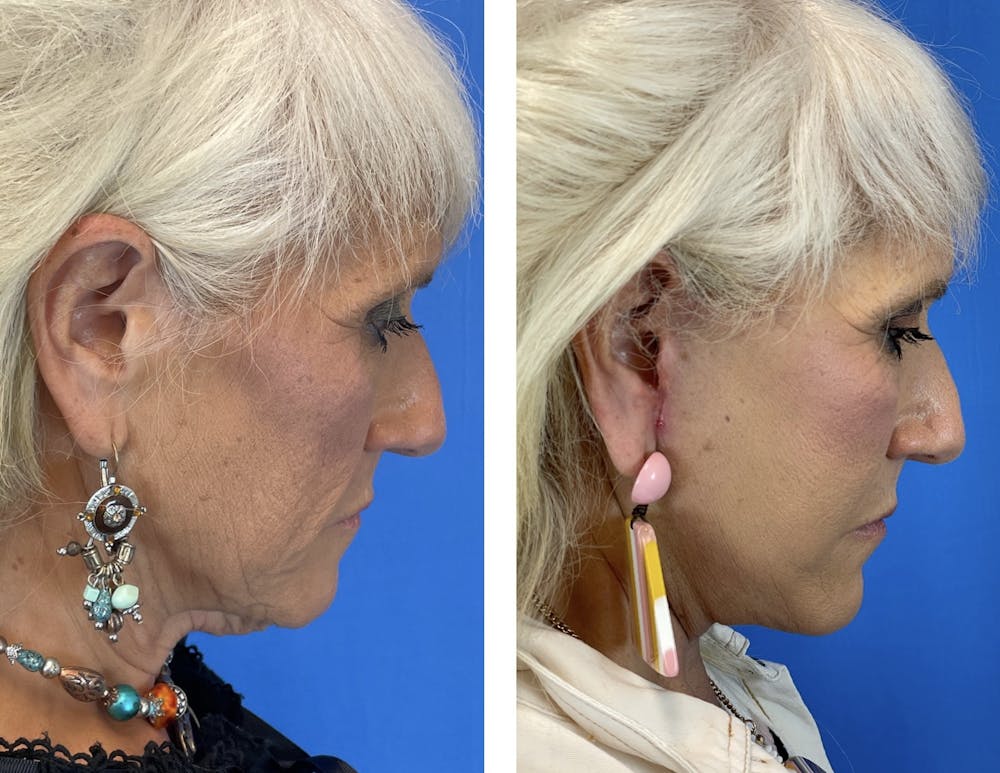 Facelift Before & After Gallery - Patient 101164267 - Image 2