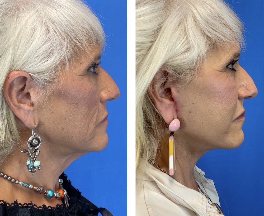 Facelift Before & After Gallery - Patient 101164267 - Image 3
