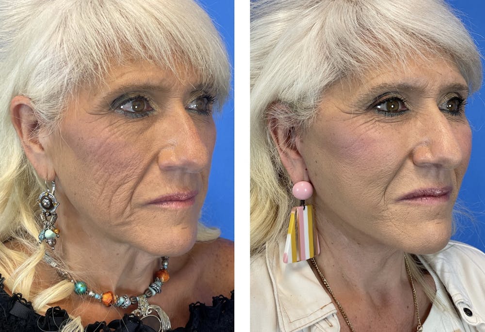 Facelift Before & After Gallery - Patient 101164267 - Image 4