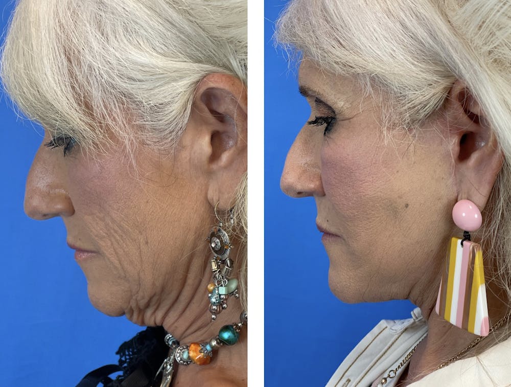 Facelift Before & After Gallery - Patient 101164267 - Image 5