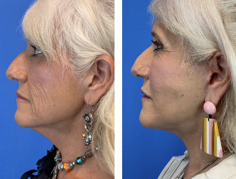 Necklift Before & After Gallery - Patient 101164268 - Image 3