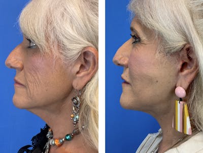 Facelift Before & After Gallery - Patient 101164267 - Image 6