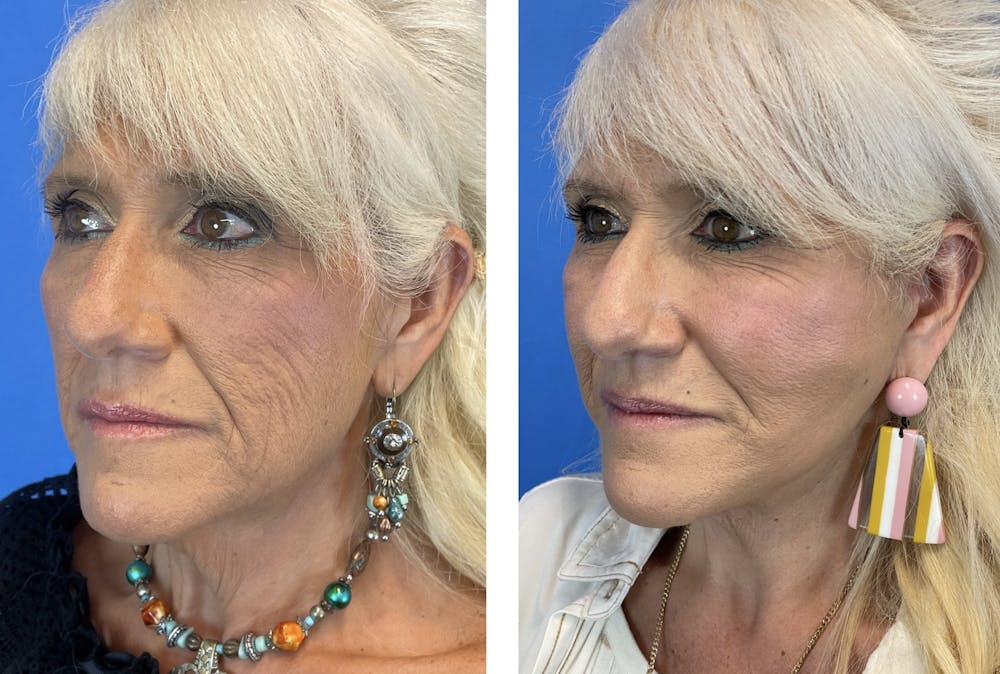 Facelift Before & After Gallery - Patient 101164267 - Image 7