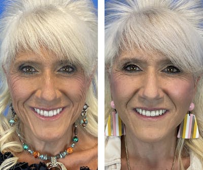 Facelift Before & After Gallery - Patient 101164267 - Image 1