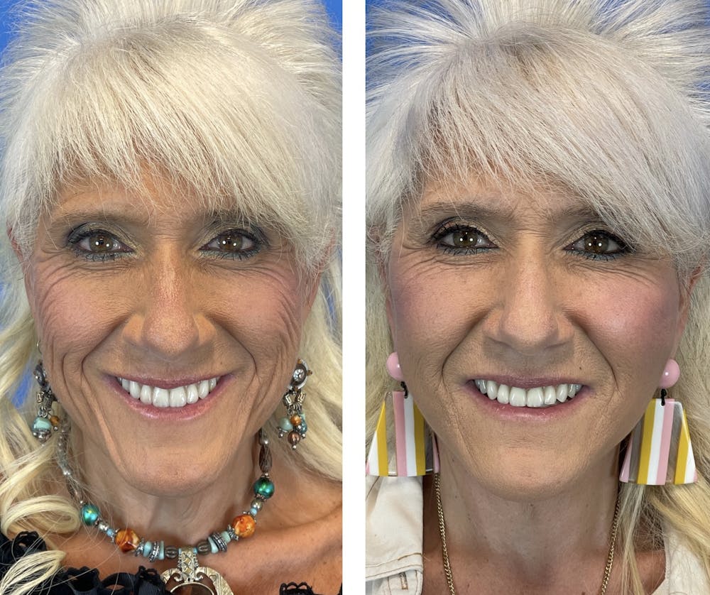 Facelift Before & After Gallery - Patient 101164267 - Image 1