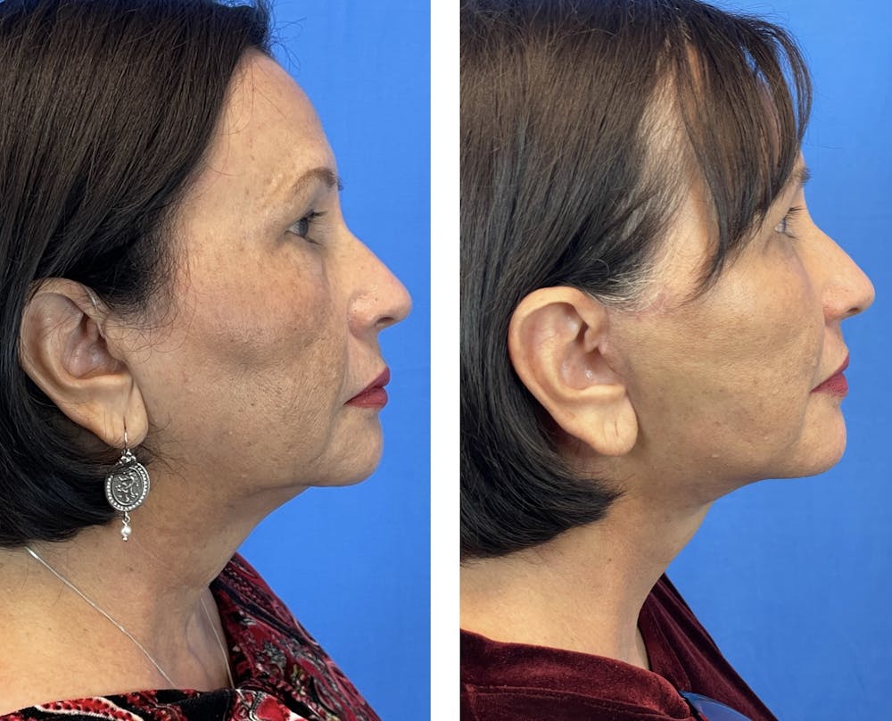 Facelift Before & After Gallery - Patient 101164281 - Image 7
