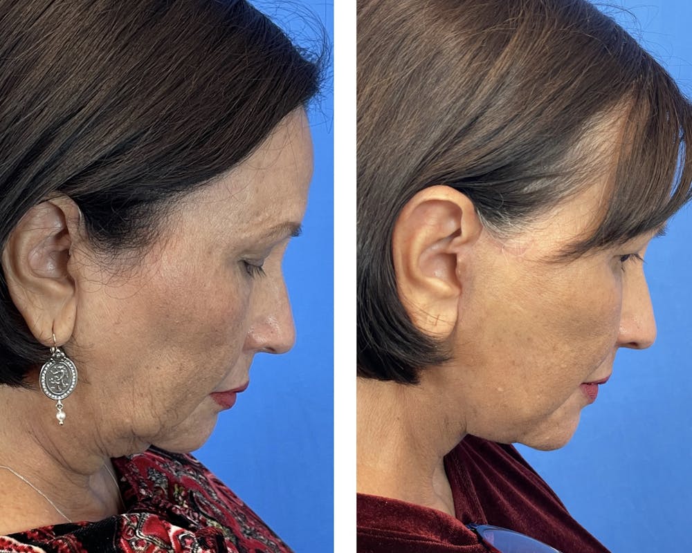 Lower Blepharoplasty Before & After Gallery - Patient 101164285 - Image 2