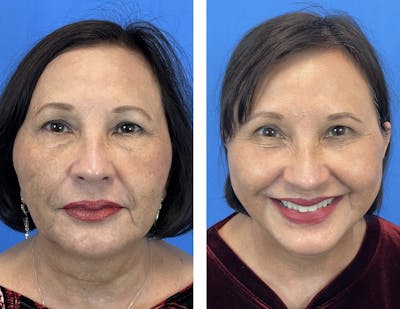 Lower Blepharoplasty Before & After Gallery - Patient 101164285 - Image 1