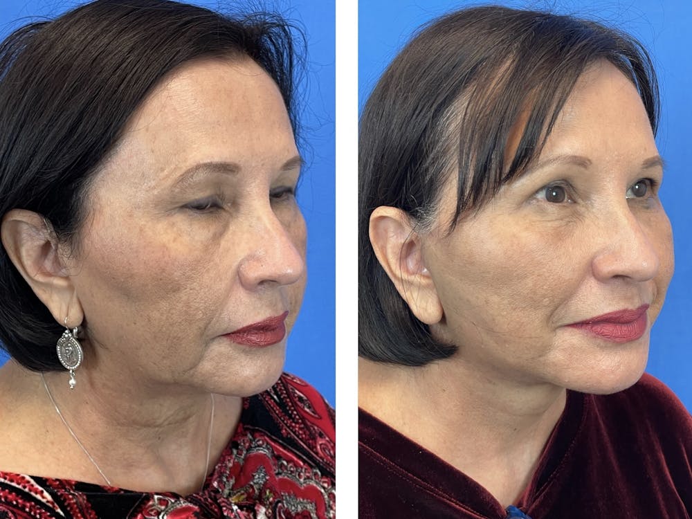 Facelift Before & After Gallery - Patient 101164281 - Image 3