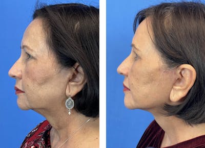 Lower Blepharoplasty Before & After Gallery - Patient 101164285 - Image 4