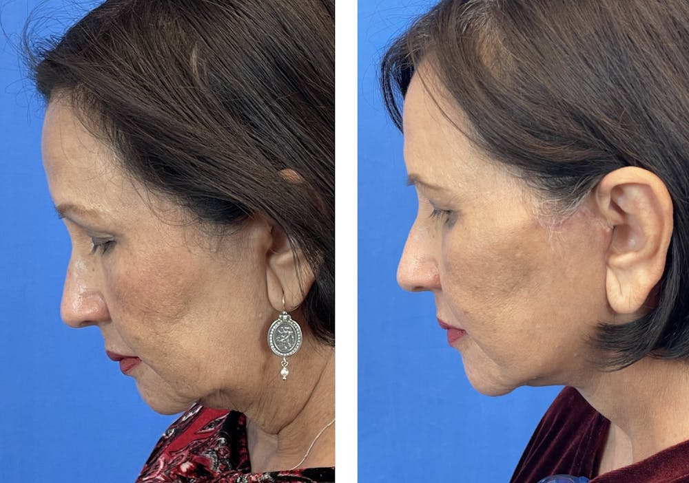 Facelift Before & After Gallery - Patient 101164281 - Image 5
