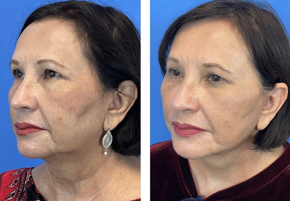 Lower Blepharoplasty Before & After Gallery - Patient 101164285 - Image 6