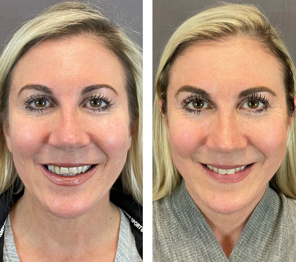 Upper Blepharoplasty Before & After Gallery - Patient 101181885 - Image 3