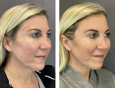Necklift Before & After Gallery - Patient 101181884 - Image 2
