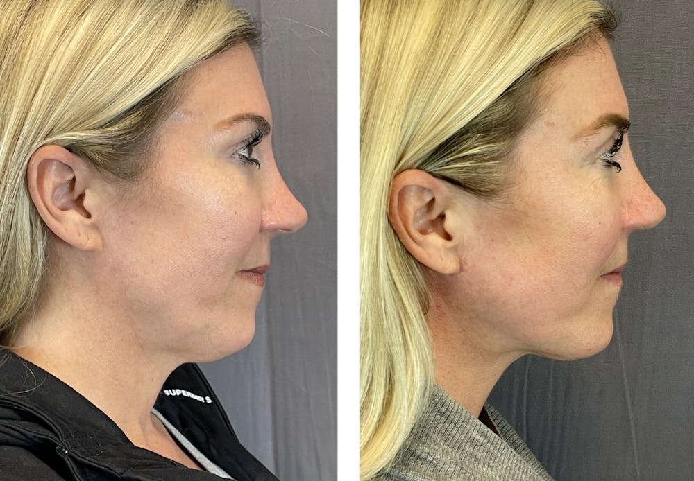 Facelift Before & After Gallery - Patient 101181883 - Image 3