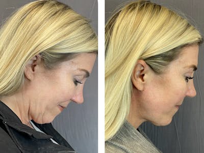 Necklift Before & After Gallery - Patient 101181884 - Image 4