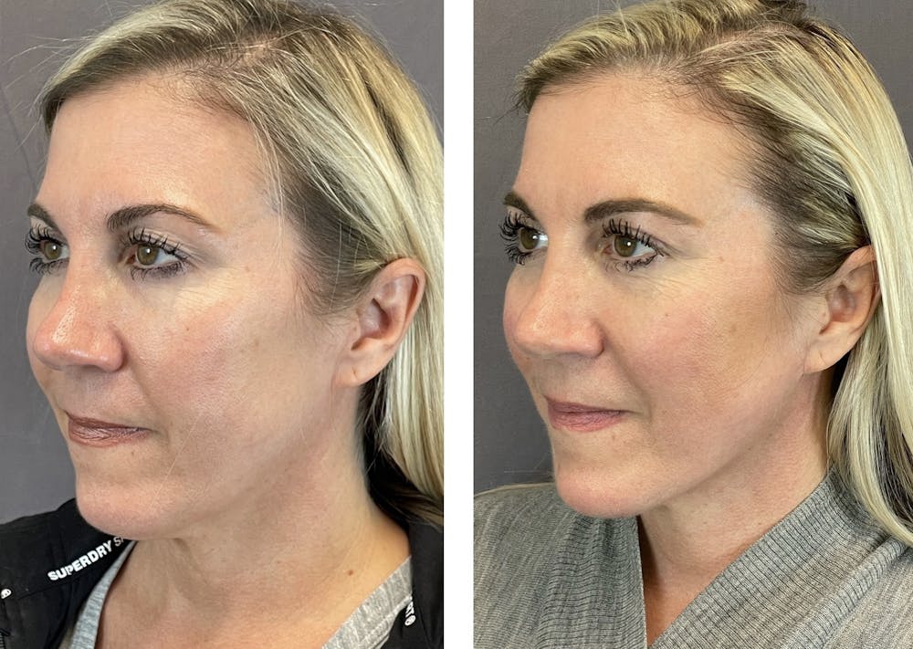 Necklift Before & After Gallery - Patient 101181884 - Image 5