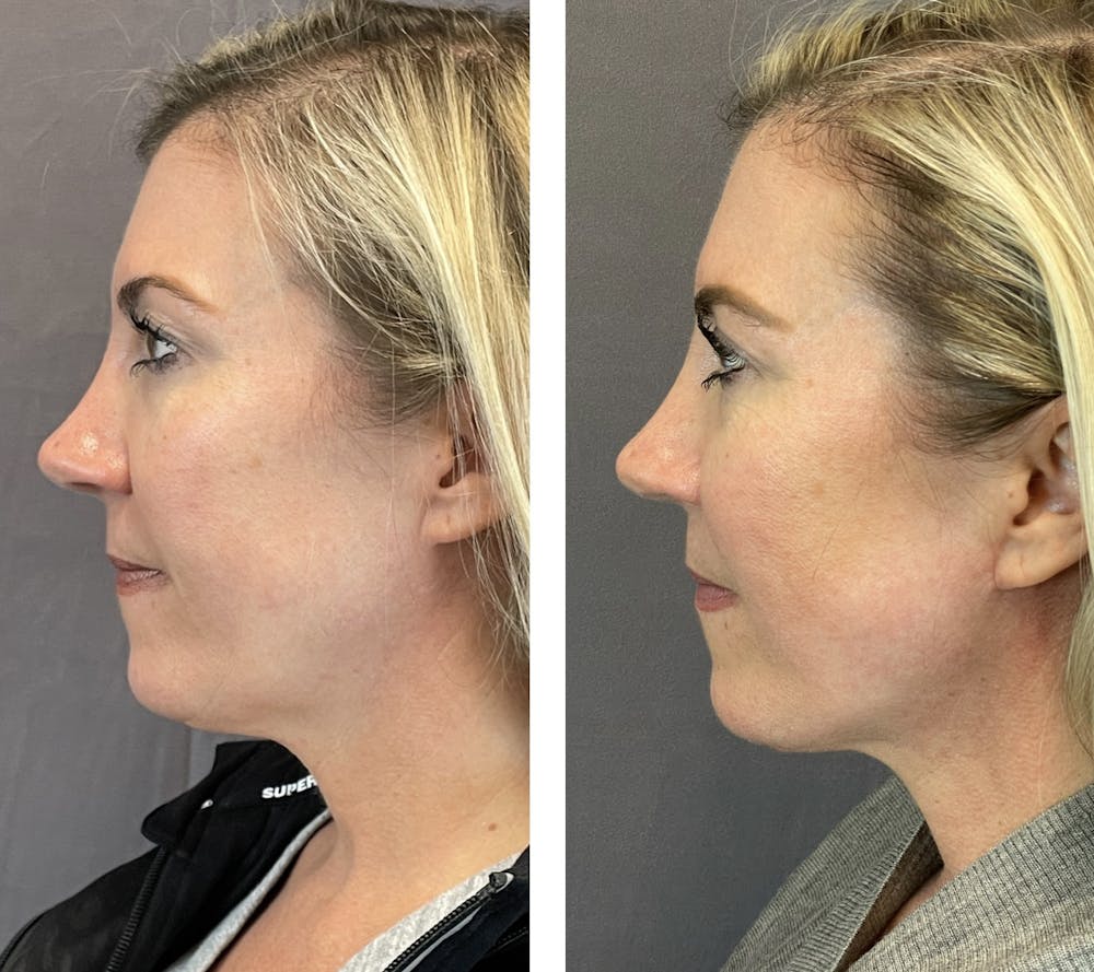 Necklift Before & After Gallery - Patient 101181884 - Image 6