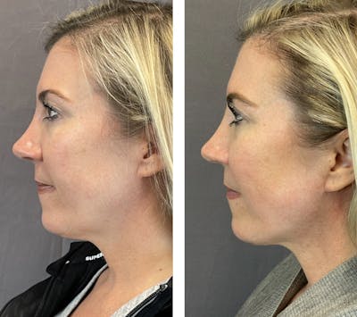 Facelift Before & After Gallery - Patient 101181883 - Image 6