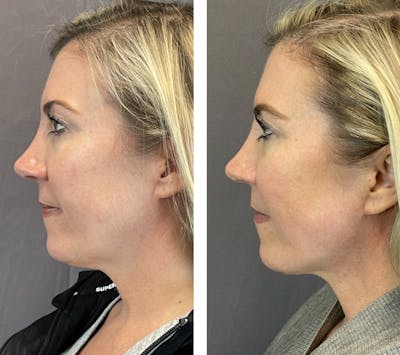 Necklift Before & After Gallery - Patient 101181884 - Image 6