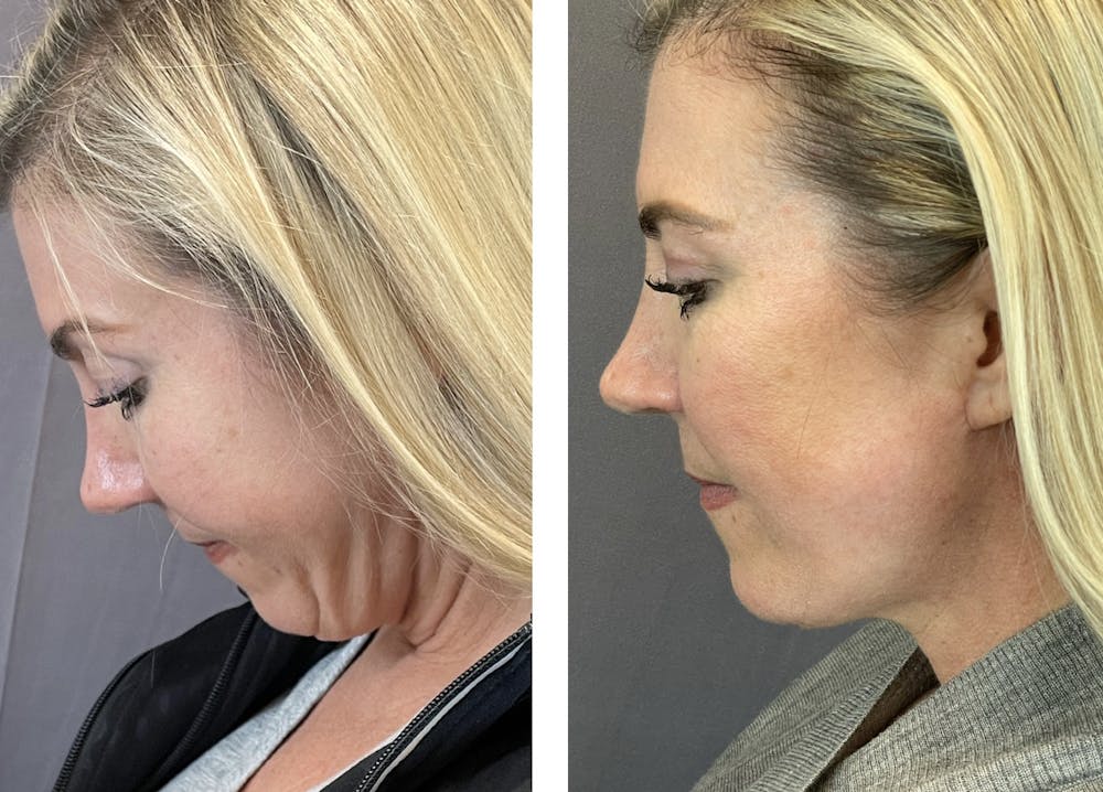 Necklift Before & After Gallery - Patient 101181884 - Image 7