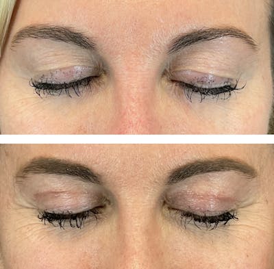 Upper Blepharoplasty Before & After Gallery - Patient 101181885 - Image 2