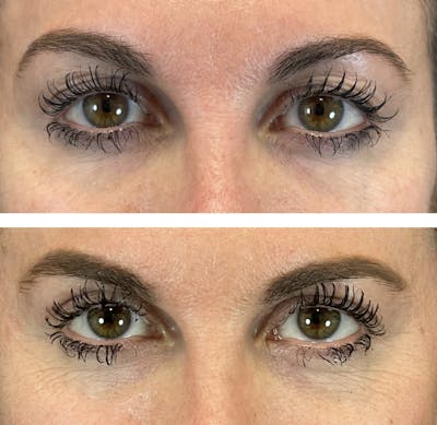 Upper Blepharoplasty Before & After Gallery - Patient 101181885 - Image 1