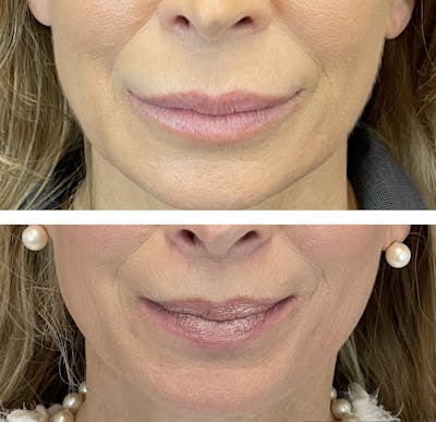 Lip Fillers Before & After Gallery - Patient 101181887 - Image 4