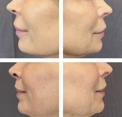 Lip Fillers Before & After Gallery - Patient 101181887 - Image 2