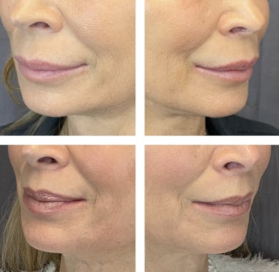 Lip Fillers Before & After Gallery - Patient 101181887 - Image 1